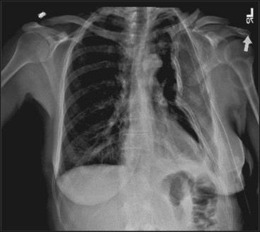 Fig. 49.2, An anteroposterior chest radiograph of a 45-year-old female driver after a motor vehicle collision. The “implosion” effect, resulting from forces to the superior and lateral shoulder, can be appreciated, resulting in fractures of the scapula, clavicle, and ipsilateral chest wall.