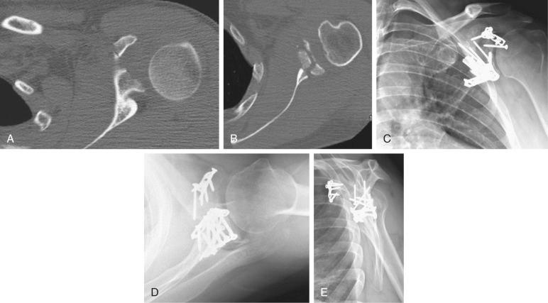 Fig. 49.21, Axial CT slices show (A) a displaced coracoid base fracture and (B) a highly comminuted intraarticular glenoid fracture with both anterior and posterior fragments. This fracture required both anterior and posterior approaches to restore the scapular anatomy as shown in (C) Grashey, (D) axillary, and (E) scapula Y radiographs taken 1 year after reconstruction.