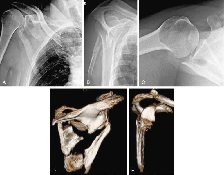 Fig. 49.5, Three plain radiographic views should be evaluated in the scapula workup: (A) anteroposterior Grashey, (B) scapula Y, and (C) axillary views. Three-dimensional computed tomography (3-D CT) reconstructions (D and E) of the same fracture illustrated in A–C provide a clearer picture of fracture lines and displacement characteristics. 3-D CT scans have proven to be the gold standard, with higher intrarater and interrater reliability scores in measuring displacement accurately, and should be obtained in patients under surgical consideration.