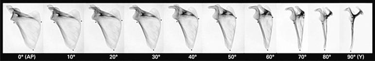 Fig. 49.6, Serial representative images taken in 10-degree increments starting from a true anterior-posterior (AP) view of the scapula. This series of radiographs highlights the fact that incorrect patient positioning leads to inaccurate displacement measurements. The glenoid articular surface will appear as a sharp crescent when a satisfactory true AP view is obtained, while a satisfactory transscapular Y view is characterized by the radiodensity from the acromion base oriented posteriorly, and the coracoid anteriorly with the overlapping superomedial angle, and finally the distal arm consisting of the bony overlap of the lateral and medial borders of the body, at least in the intact or nondisplaced state.