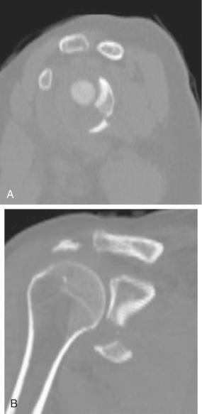 Fig. 49.7, Two-dimensional computed tomography (2-D CT) scan with sagittal and coronal reformats is helpful in measuring step and gap of articular fragments.