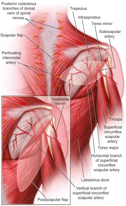 Figure 40.1, Scapular and parascapular flaps.