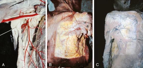 Figure 40.2, Anterior view of the right axilla of an anatomic specimen injected with colored latex. (A) The anterior lateral border of the latissimus dorsi muscle is retracted with a hook. The axillary artery, the subscapular artery, and its division into the circumflex scapular and the thoracodorsal arteries are observed. (B) Same specimen, posterior view. The superficial circumflex scapular artery and its branches are observed emerging from the triangular space. Part of the subcutaneous tissue has been removed around that space in order to show the anatomic landmarks (teres minor and major muscles). (C) Anatomic specimen injected with blue latex through the subclavian artery. The superficial circumflex scapular artery is observed.