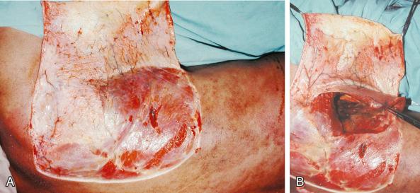 Figure 40.3, (A) Anatomic specimen injected with green latex through the subclavian artery, posterior view. A skin and subcutaneous flap was elevated from the midline toward the anterior axillary line. The parascapular artery and the muscle perforators of the thoracodorsal artery through the latissimus dorsi are visualized in the subcutaneous tissue. The deep fascia is not included in the flap. (B) Same specimen: the deep fascia and the medial part of the latissimus dorsi muscle are sectioned and elevated. The main trunk of the thoracodorsal artery is observed.