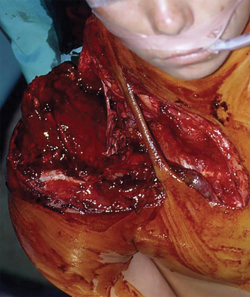 FIGURE 1, Scapulothoracic dissociation with overlying wound.