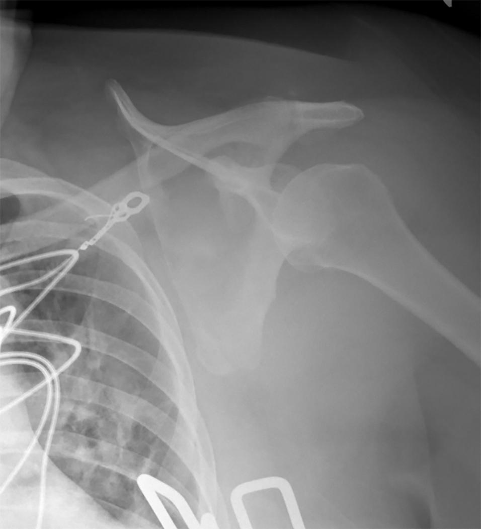 FIGURE 2, Anteroposterior chest radiograph demonstrating lateral displacement of the scapula.