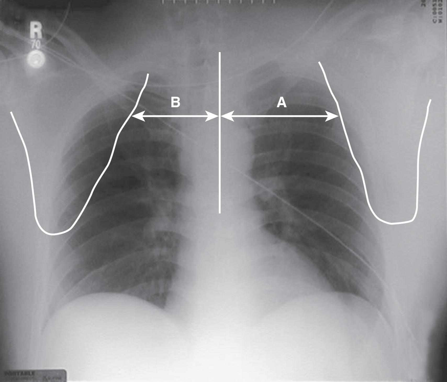 FIGURE 3, Anteroposterior chest radiograph demonstrating measurements to calculate the scapula index (A/B).