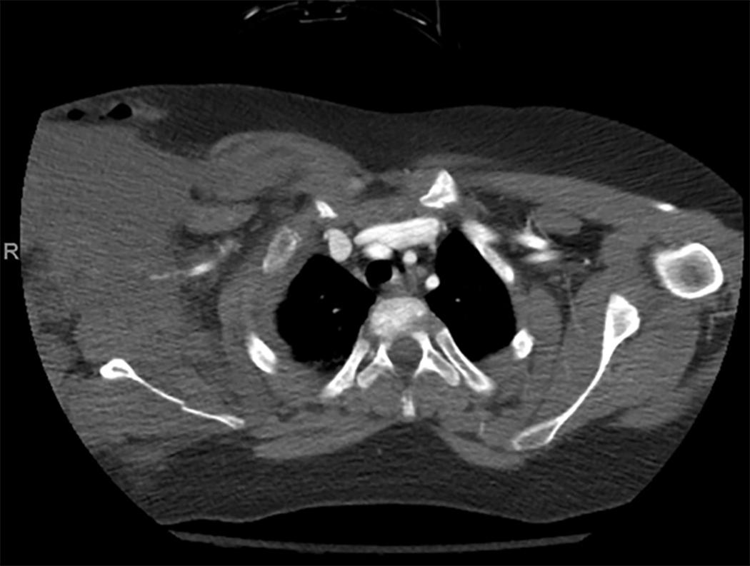 FIGURE 4, CT angiography of patient with scapulothoracic dissociation demonstrating right subclavian artery injury.