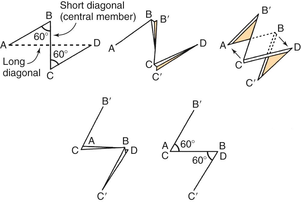 Fig. 18.6, Classic equilateral triangle 60-degree Z-plasty.