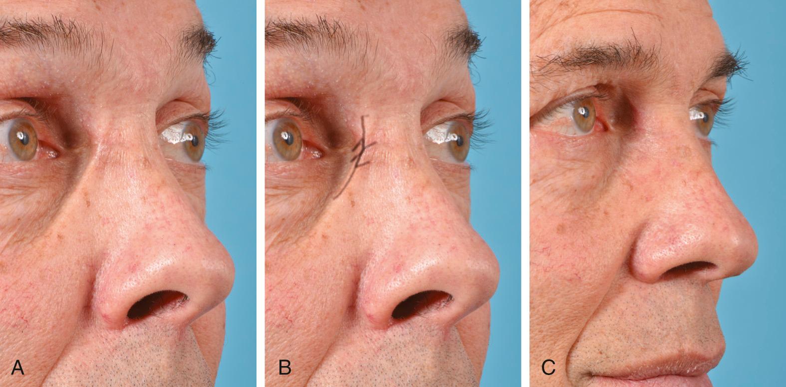 Fig. 18.7, (A) Preoperative appearance of scar with webbing near medial canthus. (B) Operative plan for Z-plasty technique. (C) Postoperative appearance.