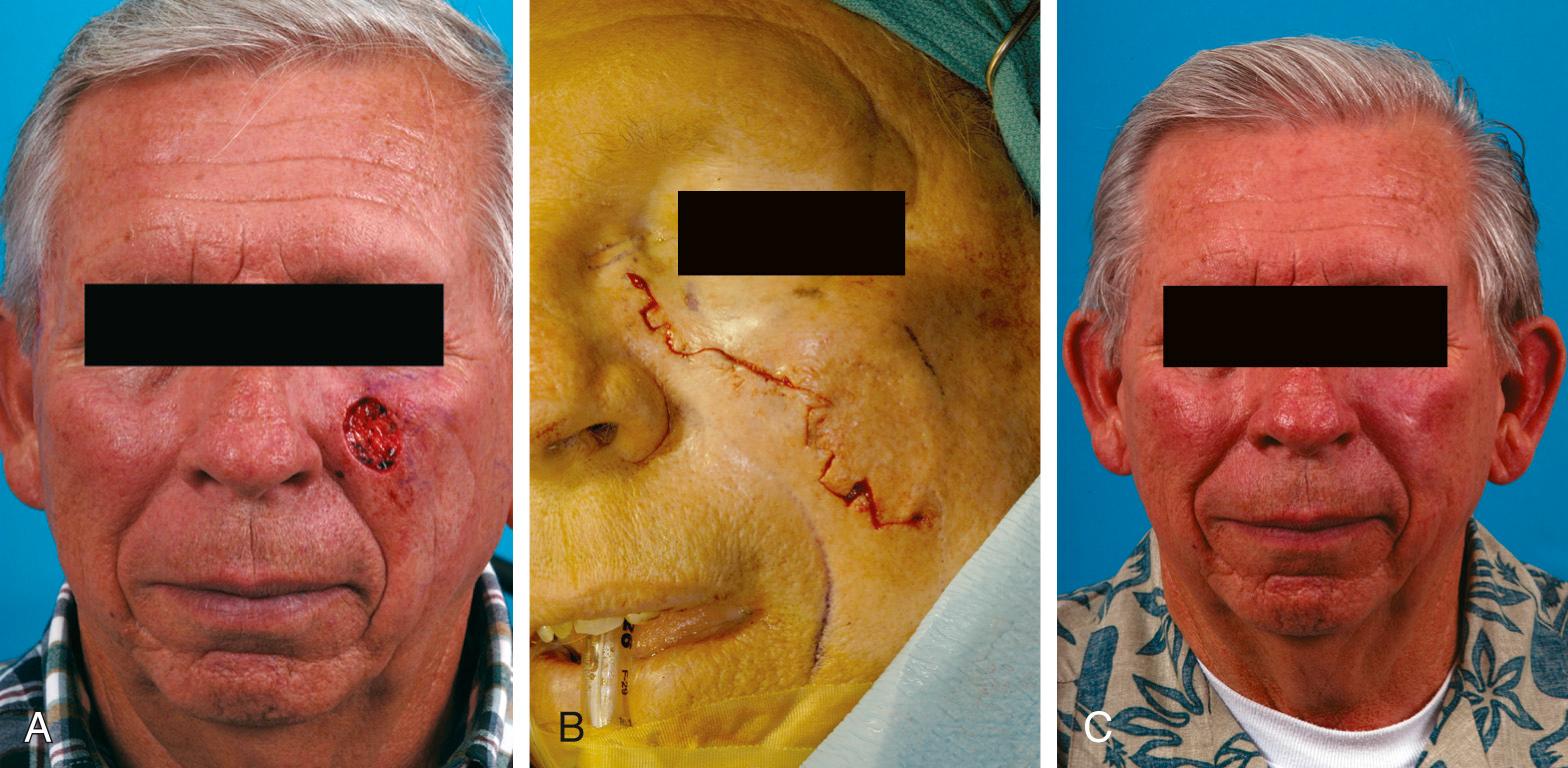 Fig. 18.9, (A) Moderate-sized Mohs defect in the left cheek. (B) Design of geometric broken-line closure that is in parallel with relaxed skin tension lines. (C) Several months postoperatively.