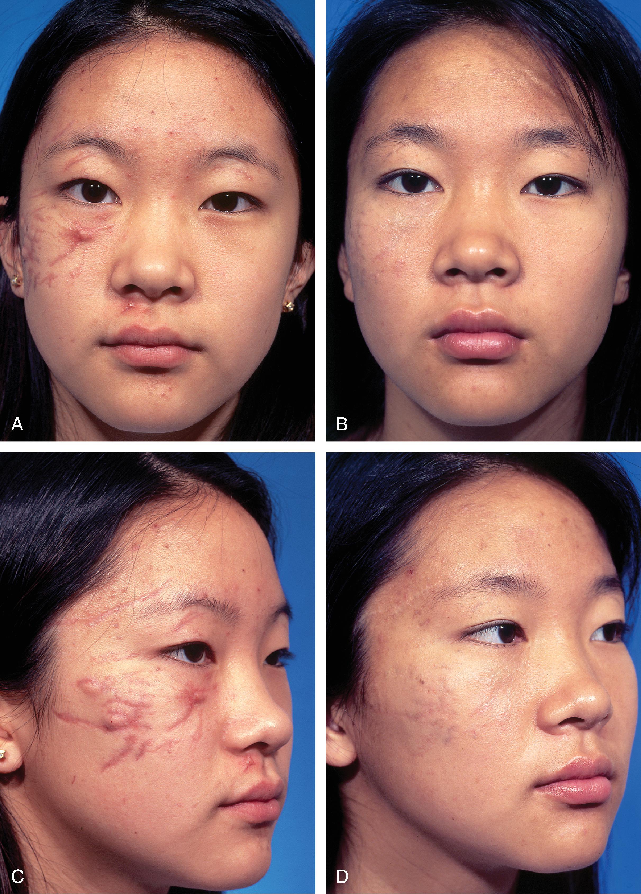 Fig. 27.1, Multiple facial scars in 13-year-old patient after automobile accident. A–D : A few weeks after accident and 3 years later. Scars matured and erythema regressed. Scars were treated with single intrascar injection of triamcinolone in select areas and silicone sheeting over all scars at bedtime for 1 year.