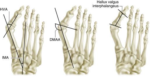 FIG. 2.1, DMAA, Distal metatarsal articular angle; HVA, hallux valgus angle; IMA, intermetatarsal angle.