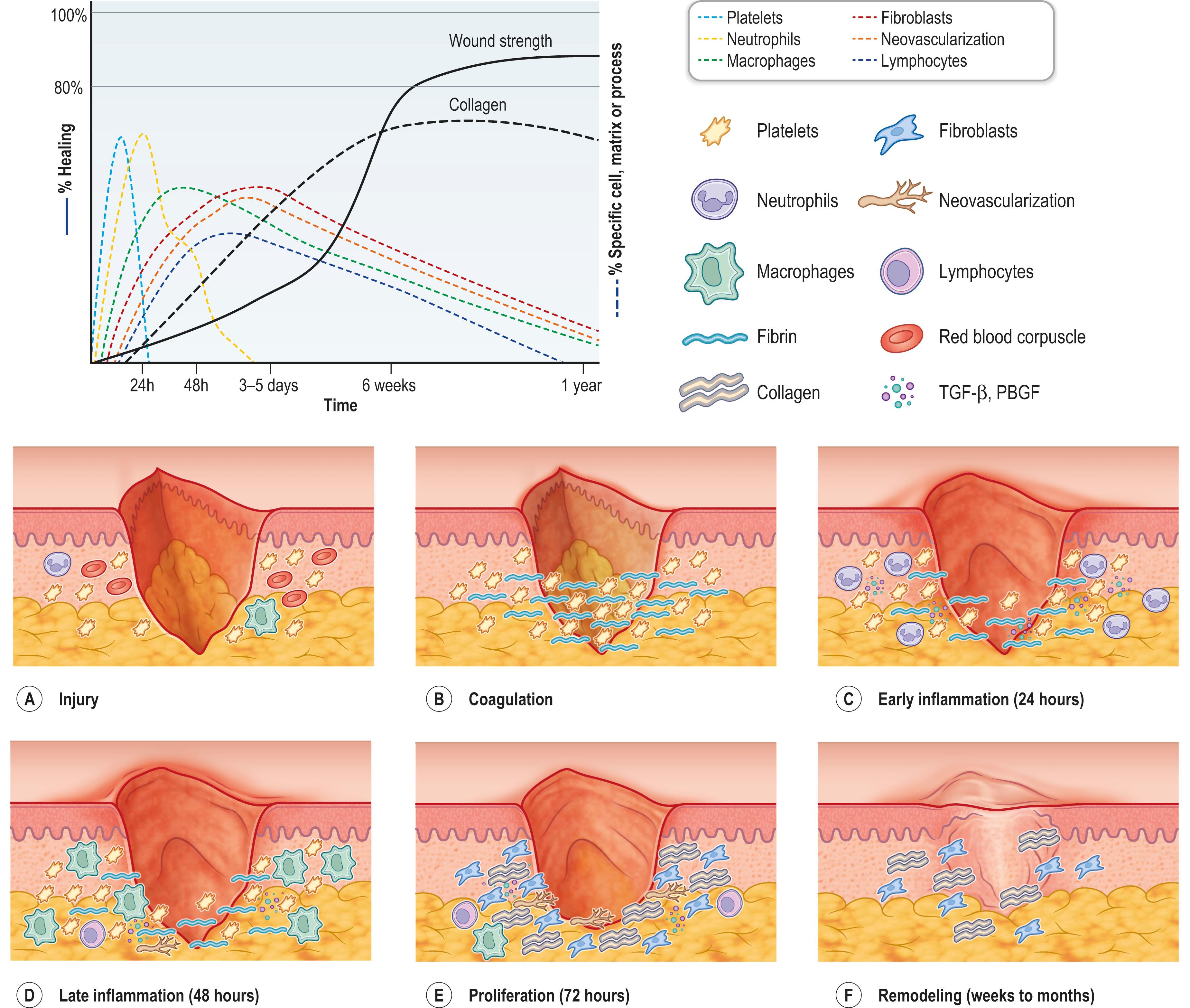 Figure 16.1, (A–F) Phases of wound healing. Wounds progress through inflammation, proliferation, and finally remodeling. Chart shows how the different cell populations within a wound contribute to skin repair over time. PDGF, Platelet-derived growth factor; TGF-β, transforming growth factor-beta.