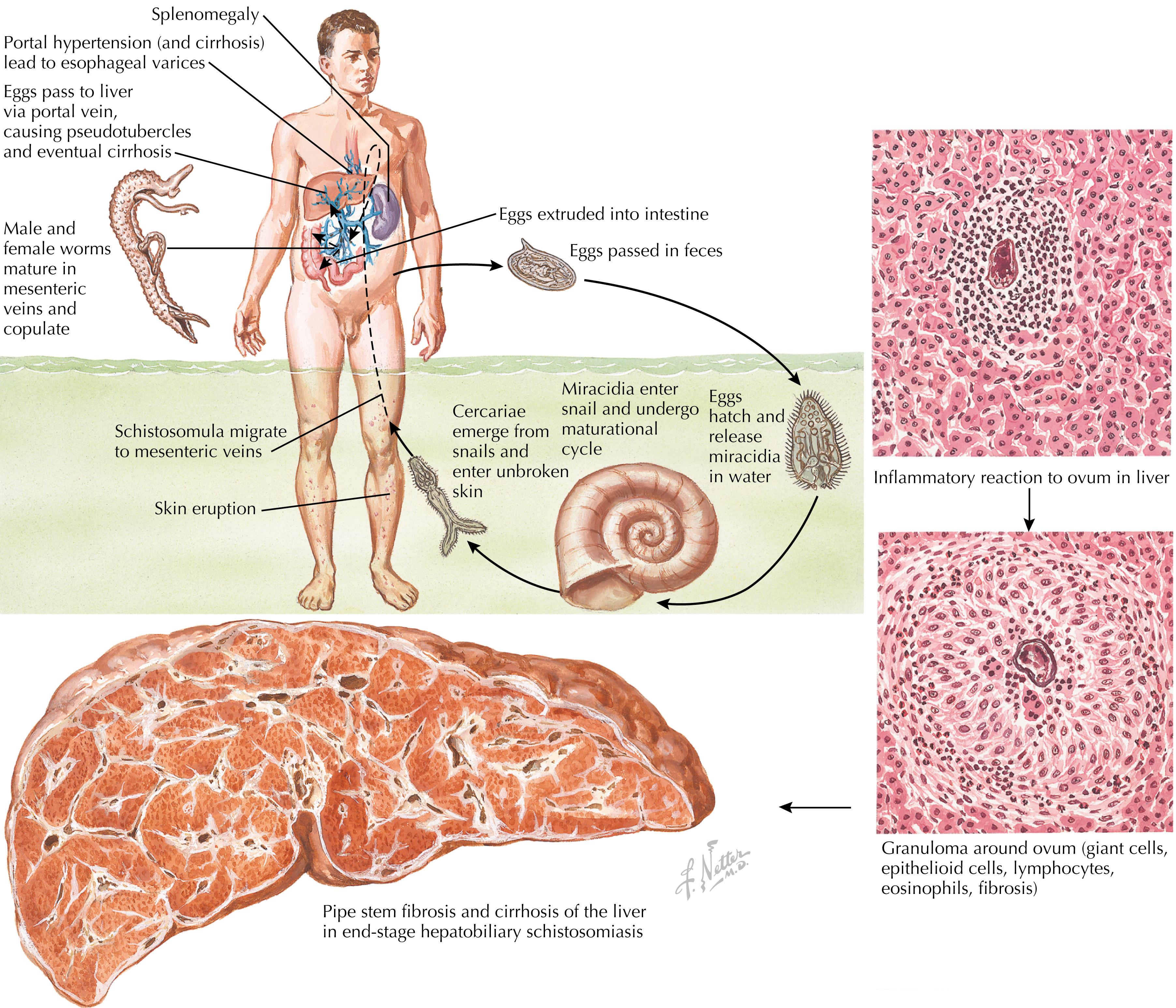 Fig. 83.2, Life cycle of Schistosoma mansoni and pathogenesis of hepatic schistosomiasis.