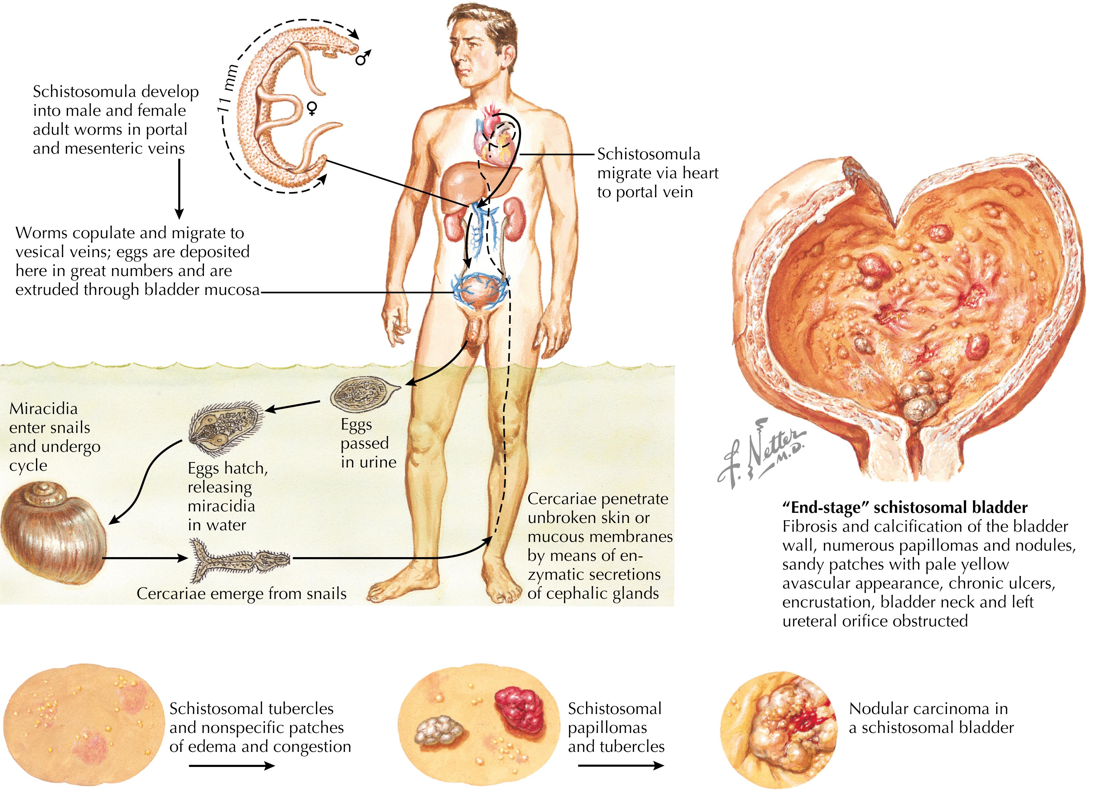 Fig. 83.3, Life cycle of Schistosoma haematobium and schistosomiasis of the urinary bladder.