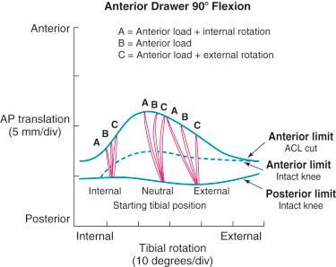 FIG 3-11, The amount of anteroposterior (AP) translation depends on the rotational position of the tibia at the beginning of the anterior drawer test. ACL, Anterior cruciate ligament; div, division.