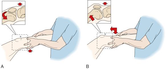 FIG 3-13, A, Flexion-rotation drawer test, subluxated position. With the leg held in neutral rotation, the weight of the thigh causes the femur to drop back posteriorly and rotate externally, producing anterior subluxation of the lateral tibial plateau. B, Flexion-rotation drawer test, reduced position. Gentle flexion and a downward push on the leg reduces the subluxation. This test allows the coupled motion of anterior translation-internal rotation to produce anterior subluxation of the lateral tibial condyle.