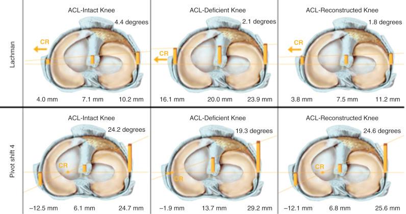 FIG 3-17, Compartment maps of a representative right knee specimen under the Lachman and simulated pivot shift test for intact, anterior cruciate ligament (ACL) deficient, and central anatomic bone-patellar tendon-bone reconstructed conditions. The data from this study showed a restoration of normal tibiofemoral compartment translation after ACL reconstruction. Loading conditions: Lachman anterior translation, 100 N; pivot shift anterior translation, 100 N; internal rotation, 1 N-m; valgus, 7 N-m. CR , Center of tibial rotation.