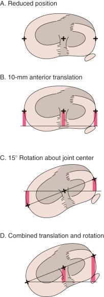 FIG 3-2, Combined anterior translation and tibial rotation. A, The tibial plateau is shown along with the contact area on the femur (shaded regions). The tibia is in a reduced position. B, Anterior tibial translation of 10 mm. The amount of translation, shown by the vertical bars, is the same at the medial and lateral joint margins as it is at the center of the joint. C, Fifteen degrees of internal rotation about the joint center. Tibial contact is anterior on the lateral plateau and posterior on the medial plateau. The bars show the amount and direction of its translation at the medial-lateral joint lines. The amount of translation is approximately 10 mm in an average knee 80 mm wide. There is no translation at the center of the joint where the rotation axis is located. D, Combined tibial translation and rotation. A 10-mm anterior translation is combined with 15 degrees of internal rotation at the medial aspect of the tibia. The center of the tibia translates 10 mm anteriorly, while the lateral joint margin translates 20 mm anteriorly.