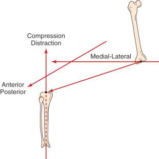 FIG 3-4, The three translations of the knee joint are motions of a point on the tibia parallel to each of the three axes. The point of the tibia used is located midway between the spines of the tibial plateau and is indicated by the arrow originating from the center point of the femur. Medial-lateral translation is motion of the point parallel to the flexion-extension axis. Anterior-posterior translation is motion of the tibial point parallel to the abduction axis, and compression-distraction translation is motion of the point along the internal and external rotation axis.