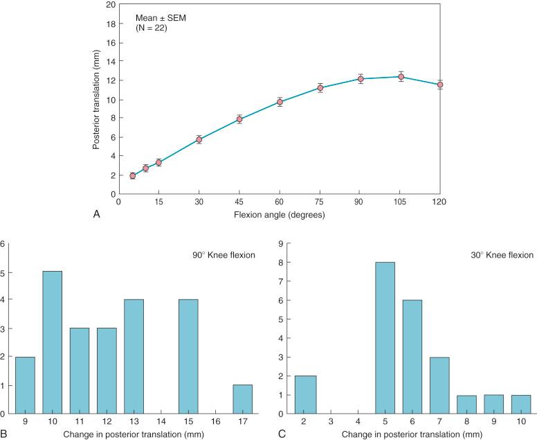 FIG 3-5, A, The increase in posterior translation is shown in 22 cadaveric knees under 100 N posterior force applied to the proximal tibia. The posterior force did not constrain the other degrees of freedom. The increase in posterior translation was 5.7 ± 0.4 mm at 30 degrees of flexion ( B ) and 12.1 ± 0.46 at 90 degrees of flexion ( C ). The data show that the majority of knees (15 of 22) that had the posterior cruciate ligament (PCL) sectioned alone had greater than 10 mm of increased posterior translation. This demonstrates the variability in knees in the physiologic tightness or slackness of the secondary restraints in resisting posterior tibial translation after PCL disruption.