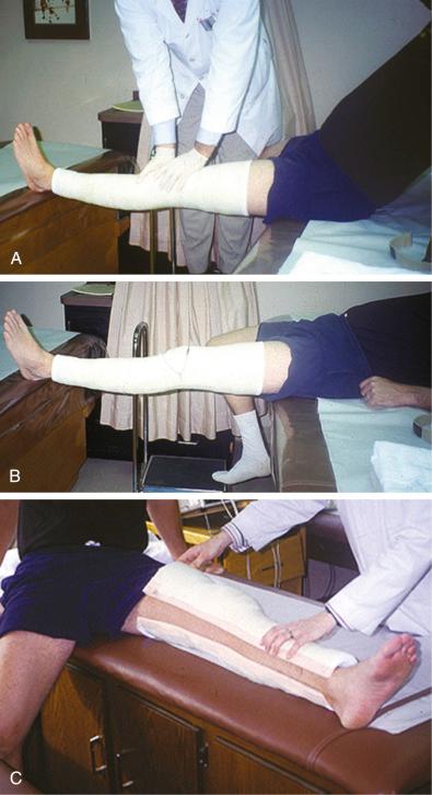 FIG 10-2, Extension cast application requires overpressure initially (A) . The cast is worn for 48 hours (B) and is then split (C) and converted into a night splint.