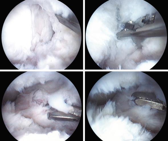 FIG 10-3, Arthroscopic debridement of scar tissues.