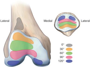 FIG 10-6, Contact surface areas on the patella and trochlea/femoral condyles at various degrees of knee flexion.