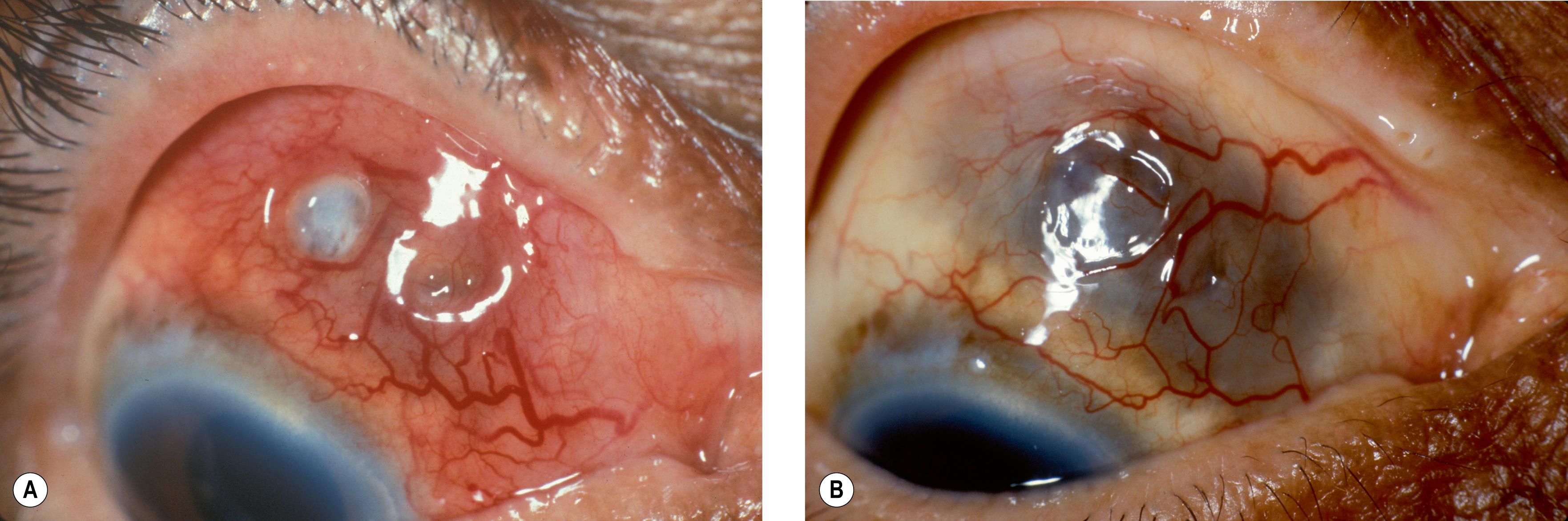 Fig. 21.1, (A) Nodular anterior scleritis in patient with rheumatoid arthritis. Inflammation of the deep scleral vessels is characterized by violaceous hue. (B) After 2 months of systemic corticosteroids, the scleral vessels are less inflamed; however, signs of scleral thinning can be noted.