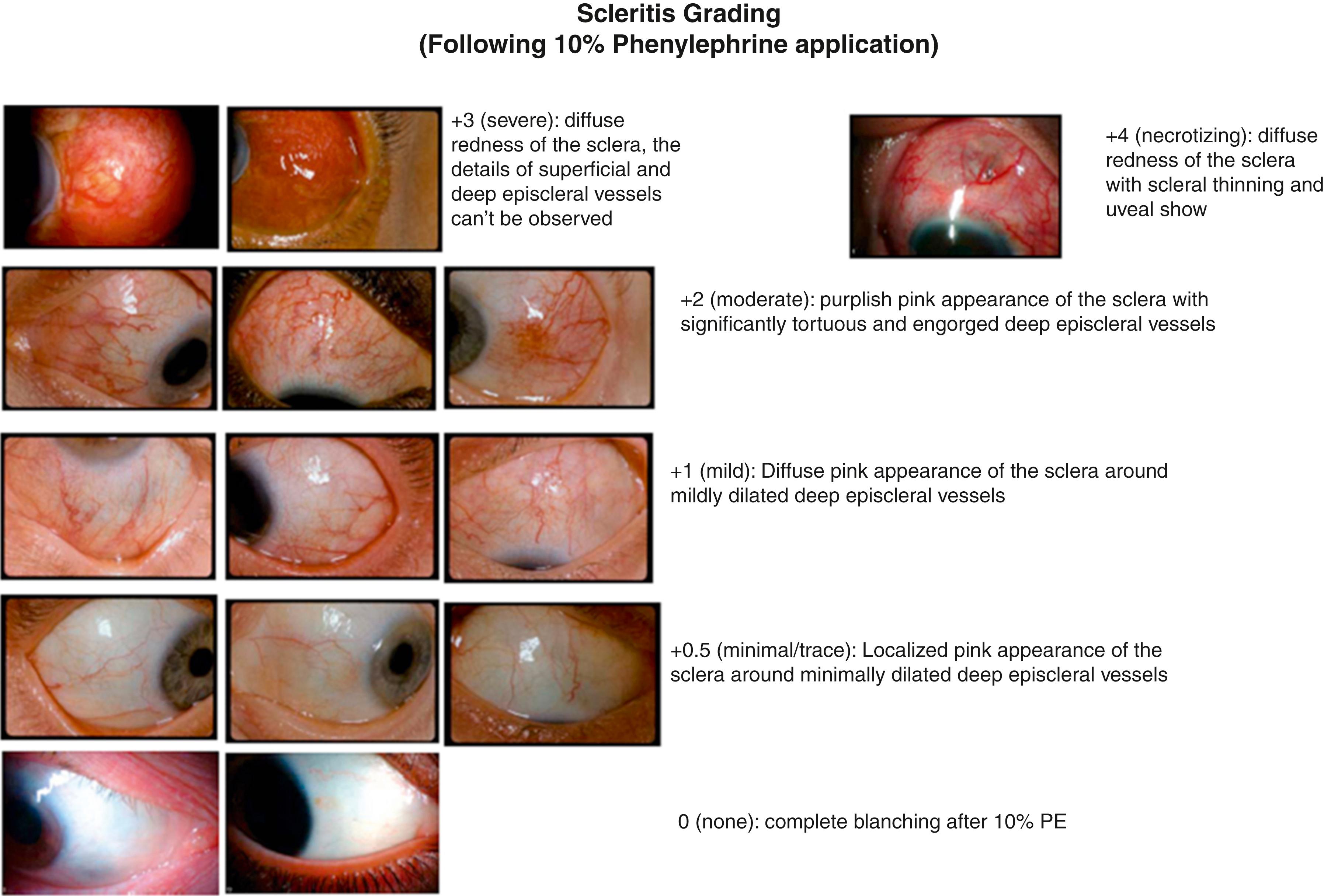 Fig. 21.2, Scleritis grading system. Standardized digital photographs of scleritis of varying severity.