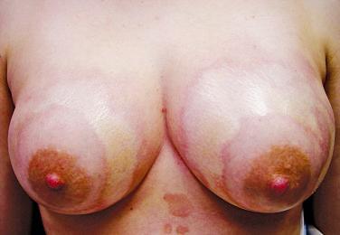 FIGURE 3-1, Sclerotic plaques of morphea on the breasts with erythematous to violaceous borders.