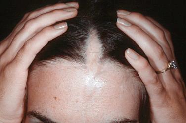 FIGURE 3-5, En coup de sabre involving the forehead and scalp.