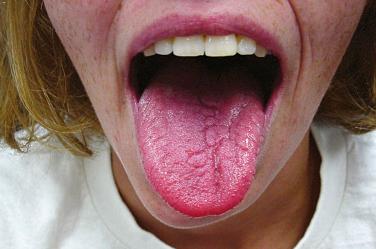 FIGURE 3-6, Hemifacial atrophy (Parry–Romberg syndrome) with atrophy of the left jaw and tongue.