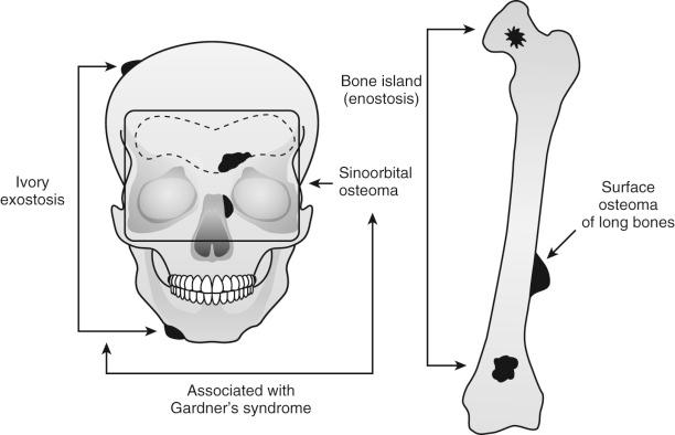 FIGURE 21-1, Clinicopathologic variants of osteoma.