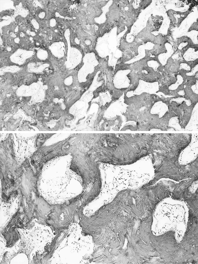 FIGURE 21-13, Giant bone island: microscopic features.