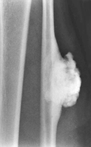FIGURE 21-14, Surface osteoma of long bone: radiographic features.