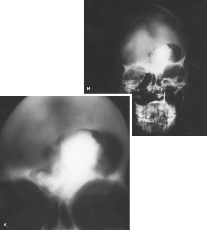 FIGURE 21-3, Sinoorbital osteoma: radiographic and microscopic features.