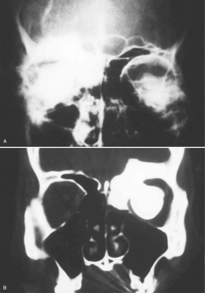 FIGURE 21-4, Sinoorbital osteoma: radiographic features.