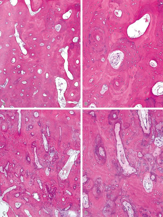 FIGURE 21-5, Sinoorbital osteoma: mircroscopic features.