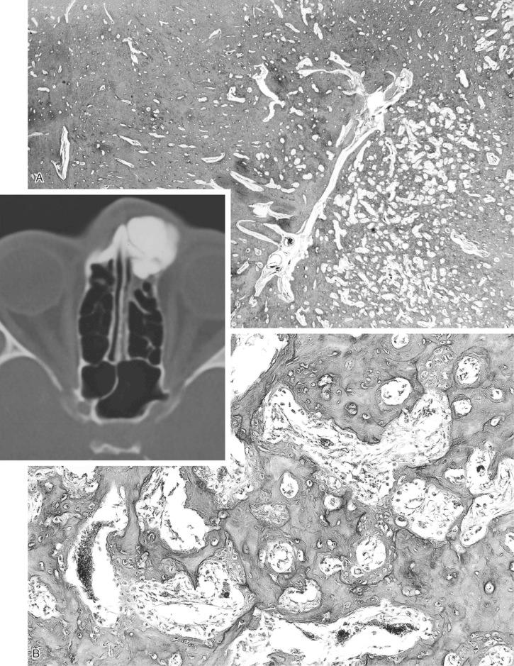 FIGURE 21-6, Sinoorbital osteomas with osteoblastoma-like areas: radiographic and microscopic features.