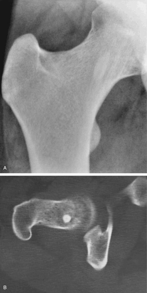 FIGURE 21-9, Bone island (enostosis): radiographic features.