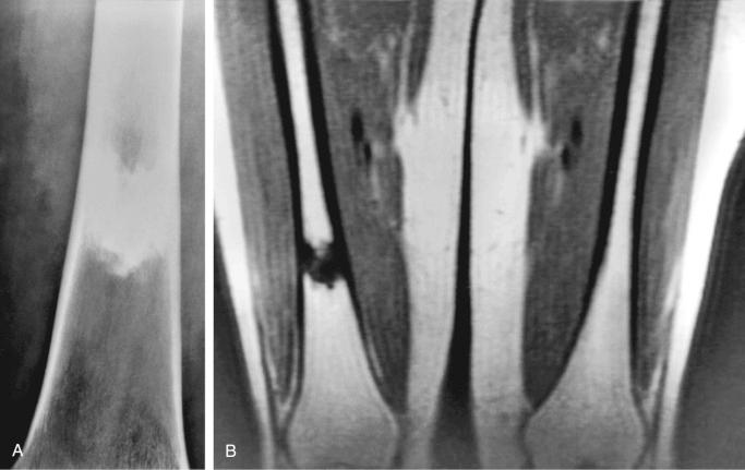 FIGURE 21-10, Giant bone island: radiographic features.