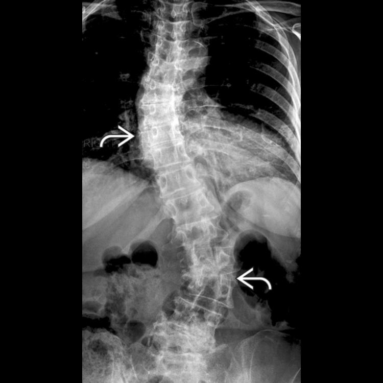 Anteroposterior radiograph shows sigmoid scoliosis of the thoracic and lumbar spines . Fusion is extended to L5 if there is fixed tilt or subluxation at L4-L5, or to the sacrum if L5-S1 central or foraminal decompression is needed.