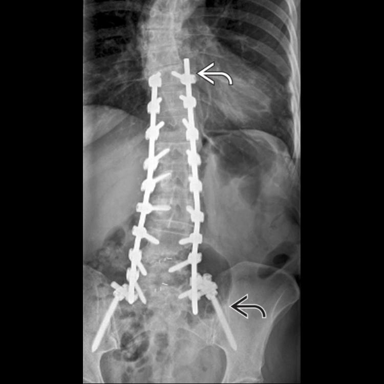 Anteroposterior radiograph depicts posterior fusion from the thoracolumbar junction to the sacrum . Extension of the fusion to the sacrum increases the incidence of pseudarthrosis and reoperation.