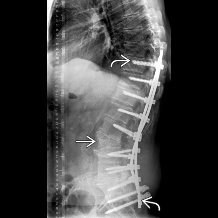 Lateral radiograph shows posterior fusion and L3 pedicle subtraction osteotomy to restore lumbar lordosis. Lumbar scoliosis results in loss of lumbar lordosis with positive sagittal balance.