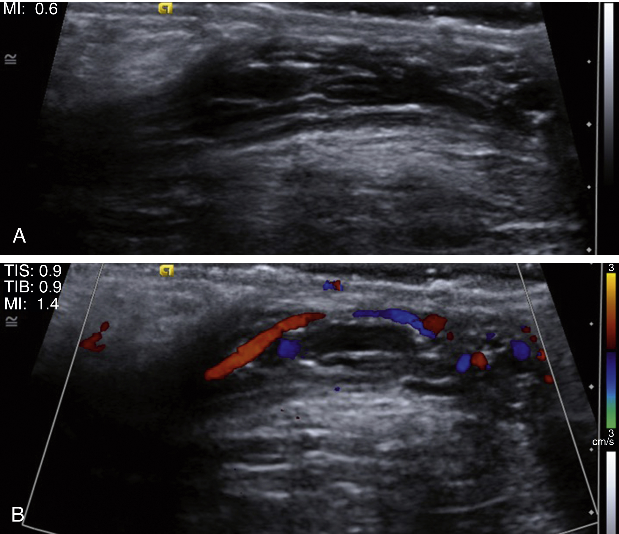 Fig. 7.3, Normal spermatic cord.