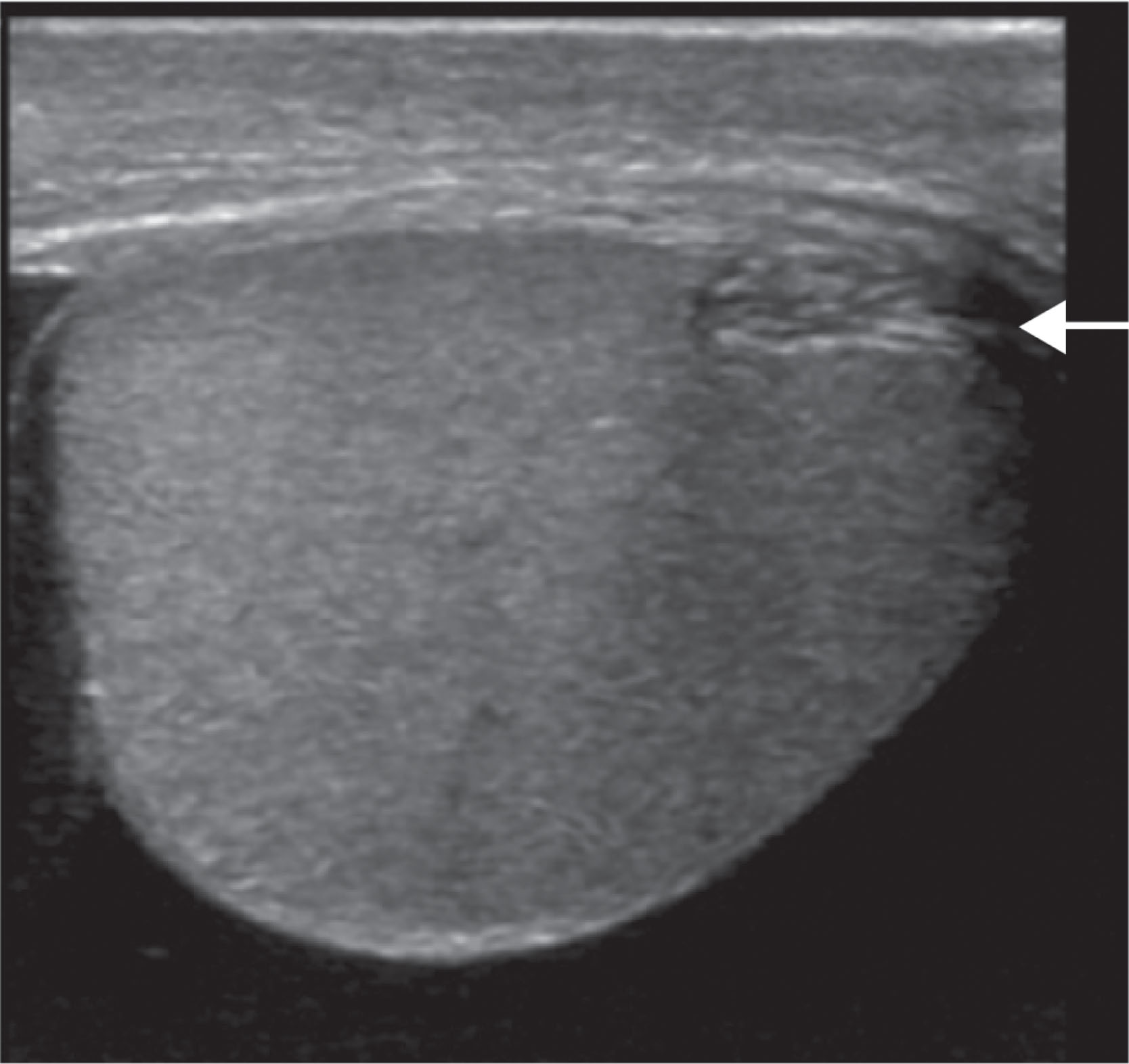 Fig. 23.1, Transverse ultrasound scan of the normal rete testis.