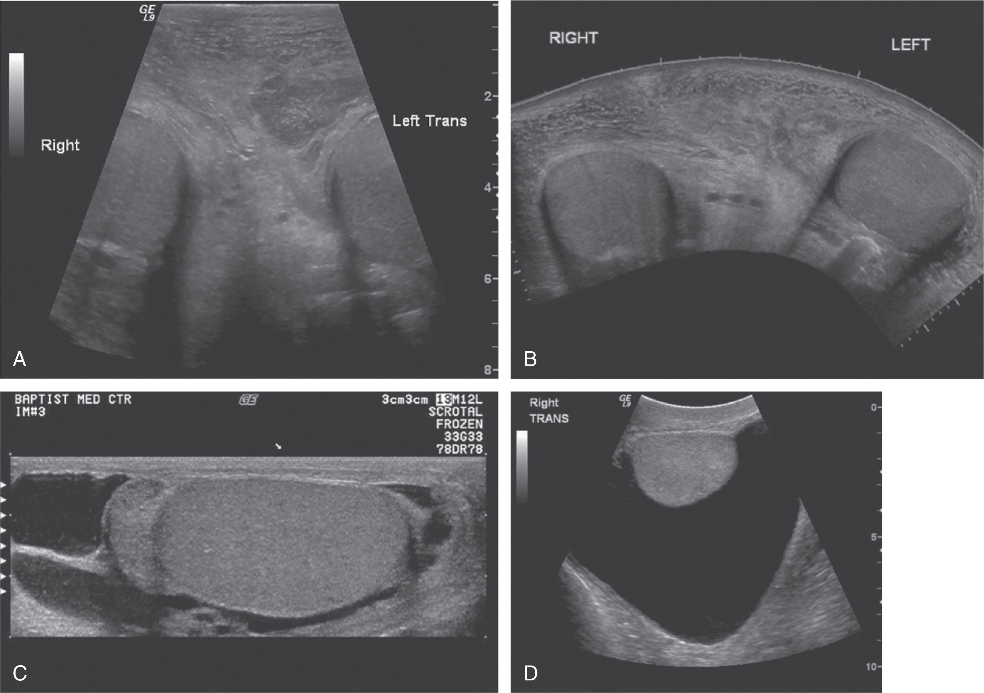 Fig. 23.11, (A) Transverse ultrasound scan of a scrotal hematoma using a virtual convex to create a sector or trapezoidal format using a linear-array probe. The field of view is enlarged to allow better depiction of the size and location of the hematoma compared with the testes. This feature is useful for measuring testicular length and showing abnormal areas that are too large to view with the standard linear format. However, because the scan lines are steered to create this image, lateral resolution is decreased compared with the standard format. (B) Transverse ultrasound view of the same scrotal hematoma using a panoramic setting. This feature allows the image to build as the transducer is moved across the anatomy. It is very useful for showing large masses and anatomic relationships. (C) Sagittal ultrasound image in a patient with epididymitis and hydrocele. The image was obtained by stitching together two images in a combined mode. This is another useful tool when a larger field of view is necessary to demonstrate anatomy. (D) Sagittal ultrasound image of the testis surrounded posteriorly by a large hydrocele. The linear-array format could not display the entire hydrocele, so a 7-MHz curved-array transducer was used to better demonstrate a pathologic condition.