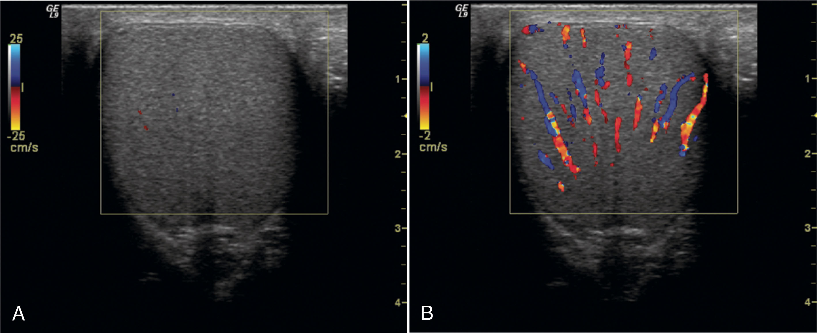 Fig. 23.12, (A) Transverse color Doppler image of a normal testis. Almost no color signal is apparent in the testis because of the high pulse repetition frequency (PRF) setting. The velocity scale values adjacent to the color bar show a velocity sensitivity of 25 cm/sec. (B) Image of the same testis, using a much lower PRF setting. The velocity scale shows a flow sensitivity of 2 cm/sec. Many intratesticular vessels can now be seen with color Doppler.